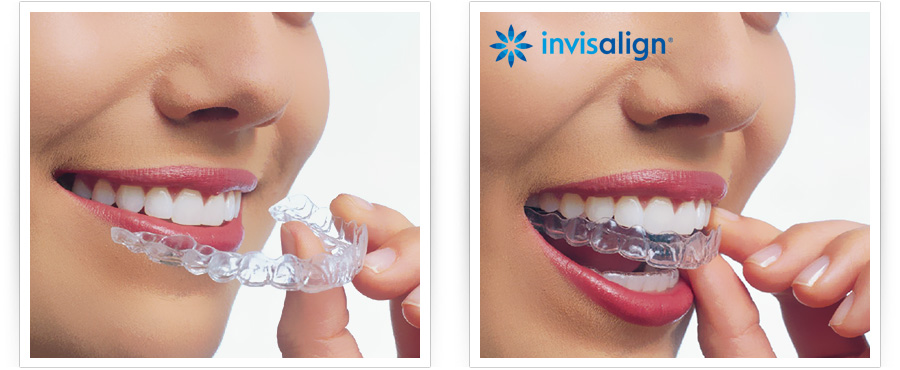 Invisalign - CROM