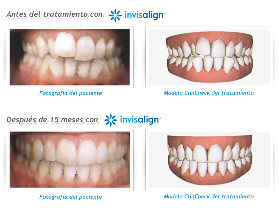 Invisalign - CROM