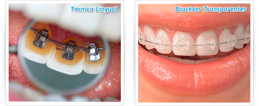 Técnica lingual y brackets transparentes - CROM