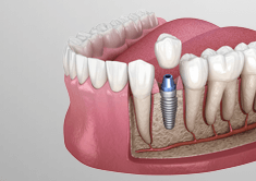 implantes y periodoncia